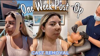 Come with me to get my cast removed 👃🫣 rhinoplasty mexico vlog [upl. by Erasaec]