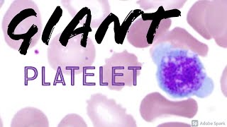 Giant Platelet on Peripheral Blood Smear Hemepath Hematology Pathology [upl. by Parrott]