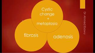 Breast fibrocystic change fibroadenosis sonomammography MRI [upl. by Vizzone]