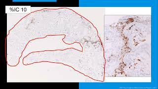 PDL1 Testing by Immunohistochemistry [upl. by Letreece]