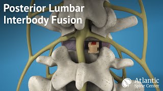 Posterior Lumbar Interbody Fusion PLIF [upl. by Aivle]