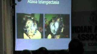 Ataxia telangiectasia  DrJBhaskar  Part 1 of 2 [upl. by Rod]