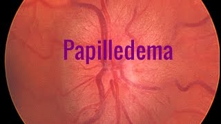 Papilledema A Swollen optic disc [upl. by Noscire]