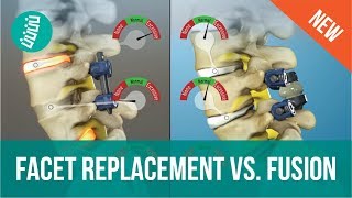 Facet Joint Replacement Vs Spine Fusion [upl. by Scherman801]