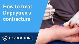 How collagenase injections treat Dupuytren’s contracture [upl. by Grani]