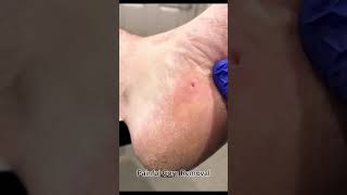 Painful corn removal foryou forpage search live doctor health [upl. by Mohr704]