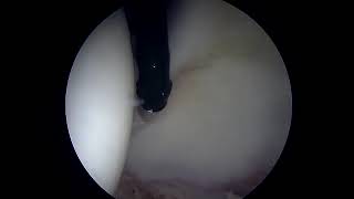 Debridement of Hyperplastic Labrum Prior to Surgical Repair [upl. by Tevlev]