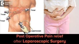 Manage abdominal pain and gas after laparoscopic surgery  Dr Nanda Rajaneesh [upl. by Helas]