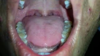 Tongue Fasciculation in MND [upl. by Goldshlag551]