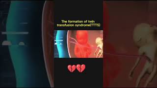 Twins Transfusion Syndromeshortsfeed mother motherhood pregnancypregnancyjourney shorts twins [upl. by Asirahc]