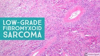 LowGrade Fibromyxoid Sarcoma Evans Tumor 101Explained by a Sarcoma Pathologist [upl. by Sally]