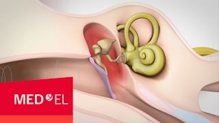 Conductive Hearing Loss Explained  MEDEL [upl. by Beghtol]