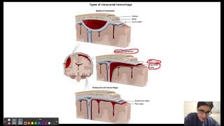 Epiduralsubdural hematomas and suture lines [upl. by Aneert51]