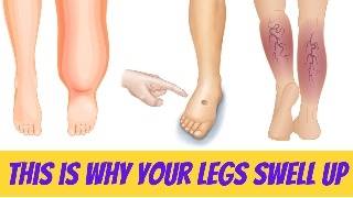 Top reasons for swollen legs [upl. by Raddatz]