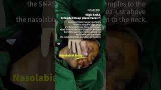 High SMAS Extended Deep plane Facelift koreaplasticsugery smasfacelift DrKwakMinho dasipium [upl. by Margo]