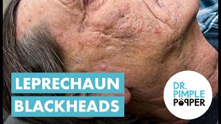 Blackhead Blackheads amp Blackheads Extended Leprechaun Blackheads [upl. by Patton649]