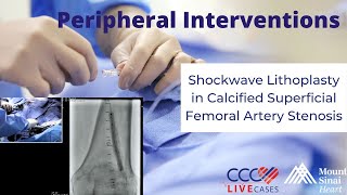 Shockwave Lithoplasty in Calcified Superficial Femoral Artery Stenosis – October 25 2017 [upl. by Kalasky]