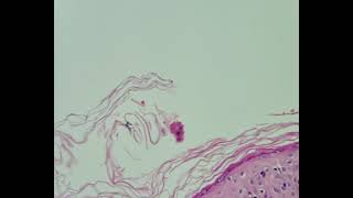 Histopathology of Lupus erythematosus [upl. by Vachil]