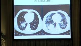 Why is invasive aspergillosis such a difficult disease to diagnose and treat [upl. by Renzo]