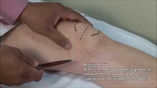 Knee Injection  Medial Approach [upl. by Comethuauc210]