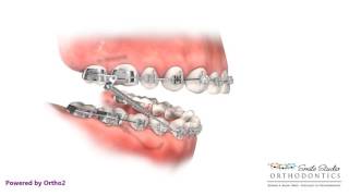 Forsus  Orthodontic Appliance [upl. by Eletnahs]