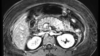 Acute Pancreatitis [upl. by Novi398]