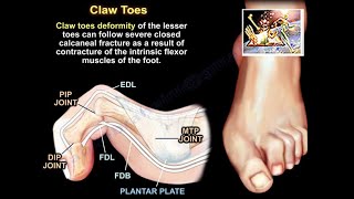 Claw Toe amp More  Everything You Need To Know  Dr Nabil Ebraheim [upl. by Moina]