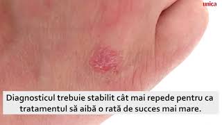 Artrita psoriazică Simptome și tratament [upl. by Alon]