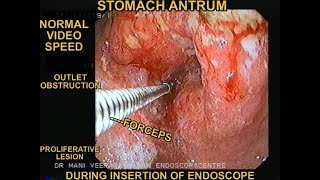 GASTRIC OUTLET OBSTRUCTION DUE TO CANCER STOMACH [upl. by Ayyidas722]