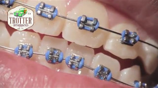 Watch How Braces Are Put On  Orthodontic Treatment Using Fixed Brackets Redondo Beach Orthodontist [upl. by Michigan77]