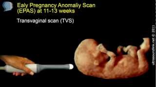 The 12 week scan transabdominal and transvaginal ultrasound [upl. by Egief483]