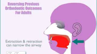 Can extractions headgear orthodontic appliances andor braces impact your airway amp breathing [upl. by Irot]