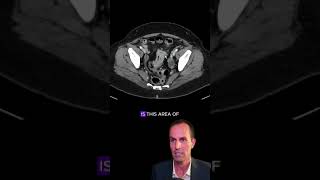 Liver metastases from colorectal cancer radiology medicalstudent radiologist surgeon oncology [upl. by Leverick]