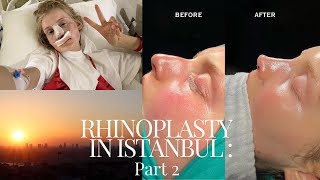 Rhinoplasty Vlog part 2  Post Op and Results [upl. by Betti]