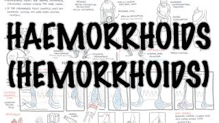 Haemorrhoids Hemorrhoids  Overview pathophysiology investigations and treatment [upl. by Lennad549]