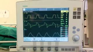 Basics of mechanical ventilation Pressure Support Ventilation [upl. by Ndnarb]