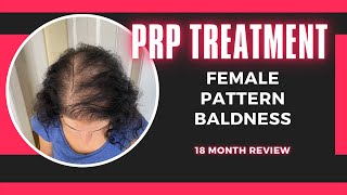 PRP Treatment for Female Pattern Baldness  18 Month Review and Final Thoughts [upl. by Arikehs824]