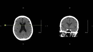 Unremarkable NonContrast Head CT Coronal Scan  Example 1 [upl. by Yenohtna]