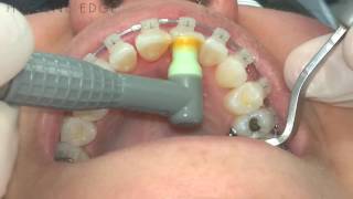 Activating SmartMode on the Nupro Freedom Cordless Prophy System  Dentsply Sirona [upl. by Eliason]