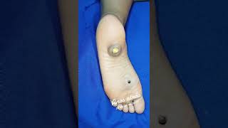 Botfly Maggot Removal spa doctor satisfying pimple removal [upl. by Ainot]