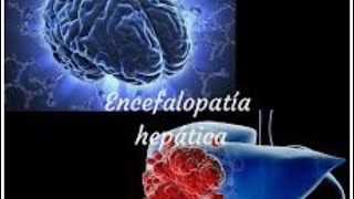 Coma Hepatico Encefalopatia hepatoamoniacal [upl. by Monagan156]