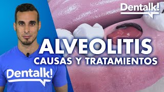 INFECCIÓN tras extracción dental ALVEOLITIS – Tratamiento síntomas y causas  Dentalk © [upl. by Aliuqaj]