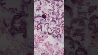 Psammoma Bodies  Pathology shorts [upl. by Yemac]