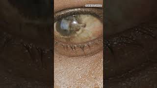 Corneal Degeneration Decoded ophthalmology mbbs neet neetpg eyedoctor shorts [upl. by Okiram394]