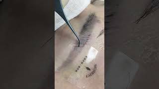 eyebrow transplantation eyebrow eyebrows sopracciglio sobrancrlhas cejas sourcils eyelashes [upl. by Brawner]