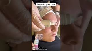 Protocolo para Acne Tulipia [upl. by Amaty]