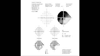 RS Visual Fields Part 2 Interpreting The Test Results [upl. by Ytinav568]