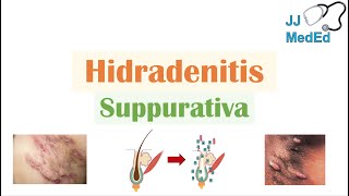 Hidradenitis Suppurativa HS  Pathophysiology Triggers Signs amp Symptoms Diagnosis Treatment [upl. by Tomas]