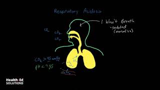 Understanding and Interpreting ABGs Part 5 Respiratory Acidosis [upl. by Ielerol793]