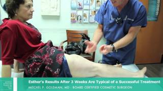 Sclerotherapy San Diego Patient Experience  Dr Mitchel P Goldman [upl. by Ahsian]